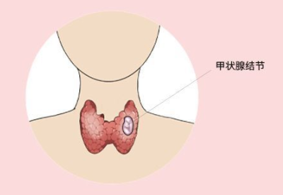 患上甲状腺结节就不能再吃海鲜了吗