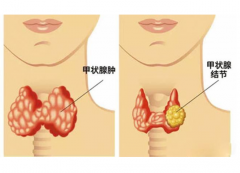 咸阳全自动尿碘检测仪品牌厂家:甲状腺癌“重女轻男”是否避碘应按治疗分类