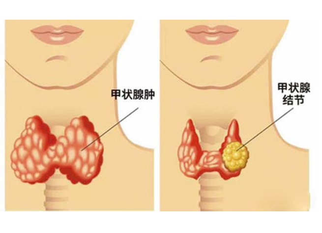 咸阳全自动尿碘分析仪品牌厂家:甲状腺癌“重女轻男”是否避碘应按治疗分类